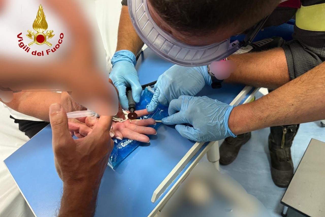 Taglio di precisione per sfilare una fede nuziale rimasta bloccata