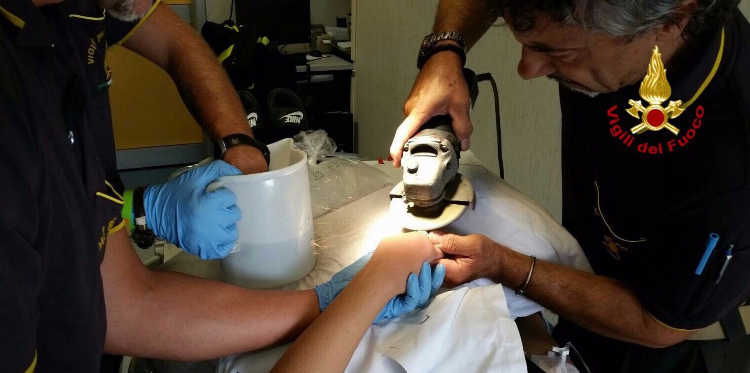 Savona, rimosso un anello in acciaio indossato da una ragazza