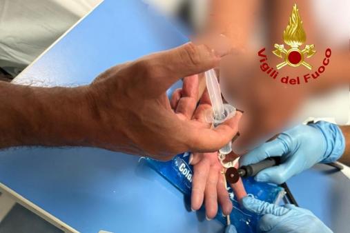 taglio di precisione per sfilare una fede nuziale rimasta bloccata al dito